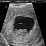 Itty Bitty Package ultrasound image in Shalimar Fort Walton Beach