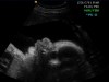 2d baby ultrasound living images fort walton beach ultrasound