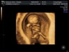 3d-4d-HD-4K-8K-ultrasound-fort-walton-beach-destin-pensacola-shalimar-florida-Little-One-_1_19