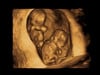 3d-4d-HD-4K-8K-ultrasound-fort-walton-beachSullivan-Twins11-weeks-3D-for-website-photo-gallery