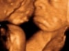 3d 4d ultrasound fort walton navarre florid fl