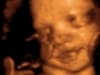 3d 4d umbilical cord ultrasound living images fort walton beach ultrasound