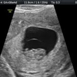 3d 4d HD 4K 8K ultrasound fort walton beach destin pensacola shalimar florida 8 weeks 4 days